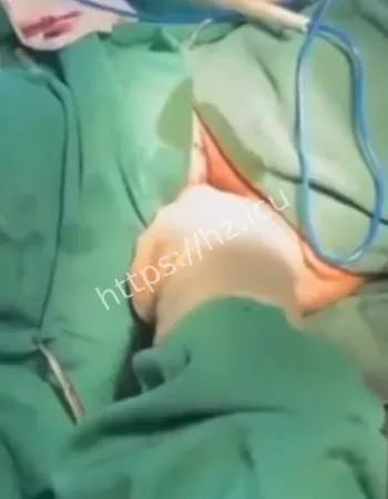 女子妇科手术直播事故