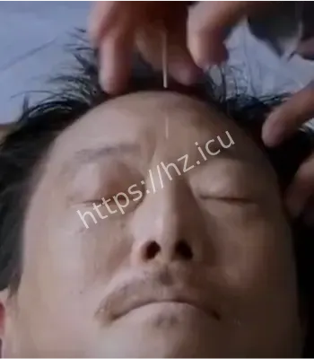 古法针灸治疗癔症原理